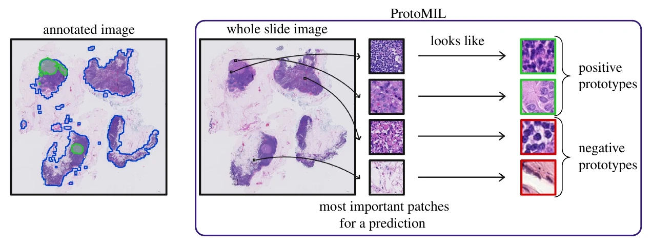 A whole-slide tissue image with highlighted regions, important image patches and matching positive and negative visual prototypes.